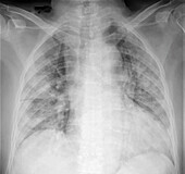 Chest X-ray of covid 19 pneumonia