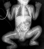 One day old baby, X-ray