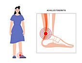 Achilles tendon injury, illustration