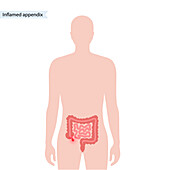 Inflamed appendix, conceptual illustration