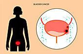 Bladder cancer stages, illustration