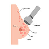 Breast ultrasound, conceptual illustration