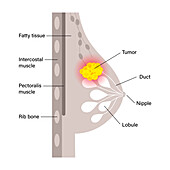 Female breast cancer, illustration