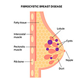 Fibrocystic breast disease, illustration