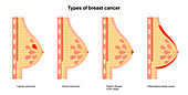 Types of breast cancer, illustration