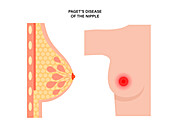 Paget's disease of the nipple, illustration