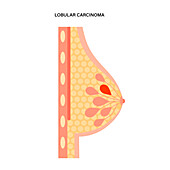 Lobular carcinoma, illustration
