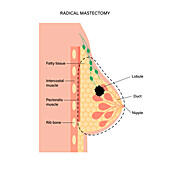 Female radical mastectomy, illustration
