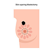Female skin sparing mastectomy, illustration