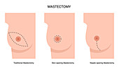 Types of female mastectomy, illustration