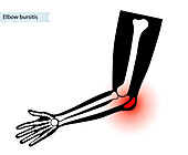 Elbow bursitis, illustration