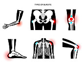 Types of bursitis, illustration