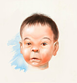Baby with foetal alcoholic syndrome, illustration