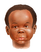 Boy with foetal alcohol syndrome, illustration