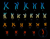 Turner's syndrome karyotype, illustration
