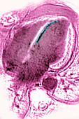 Myocarditis, MRI scan