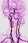 Carotid stenosis, angiography