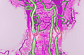 Carotid stenosis, angiography