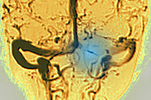 Cerebral venous thrombosis, angiography