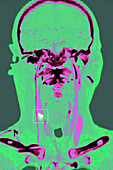 Carotid thrombosis, angioscan