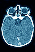 Cerebral venous thrombosis, CT scan