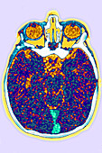 Cerebral venous thrombosis, CT scan
