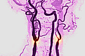 Carotid stenosis, angiography