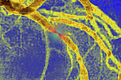 Stenosis due to myocardial infarction, angiography