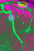 Myocardial infarction, angiography