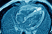 Myocarditis, MRI scan