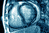 Myocarditis, MRI scan