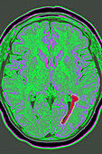 Cerebrovascular thrombosis, MRI scan