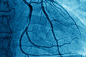Myocardial infarction, angiography