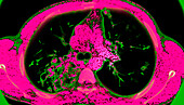 Bronchiectasis, 3D CT scan
