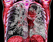 Tuberculosis, 3D CT scan