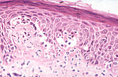 Psoriasis (guttate pattern), light micrograph