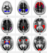 Amyloid PET scan of the brain, strongly positive