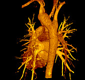 Kommerell diverticulum, 3D CT scan