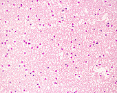 Chronic lymphocytic leukaemia, light micrograph