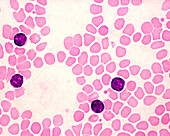 Chronic lymphocytic leukaemia, light micrograph