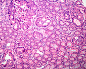 Adenocarcinoma in human colon, light micrograph