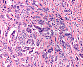 Ovarian mucinous cystadenocarcinoma, light micrograph