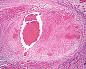 Arterial thrombosis, light micrograph