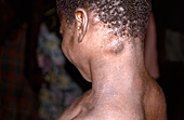 Swollen lymph node in monkeypox infection