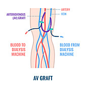 Dialysis shunt graft catheter, illustration