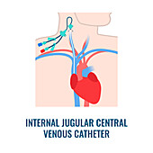 Central venous catheter, illustration