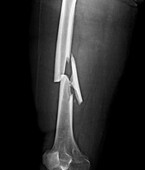 Comminuted femur fracture, X-ray