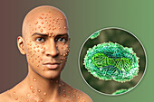 Monkeypox infection, illustration