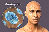 Monkeypox infection, illustration
