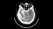 Haemorrhagic stroke, CT scan